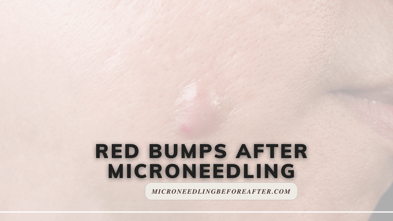 Red Bumps After Microneedling