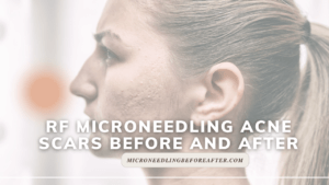 Rf Microneedling Acne Scars Before And After