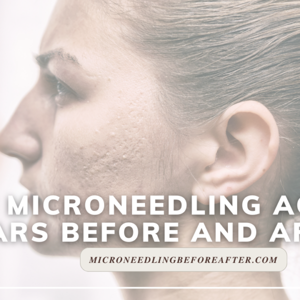 Rf Microneedling Acne Scars Before And After