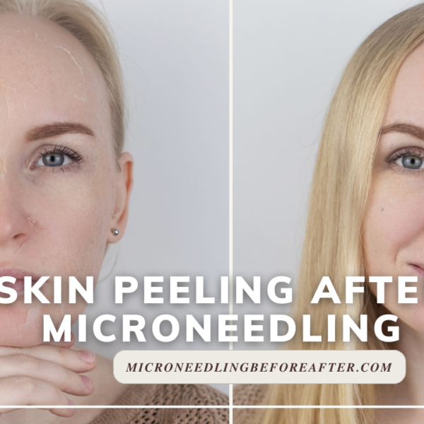 Skin Peeling After Microneedling