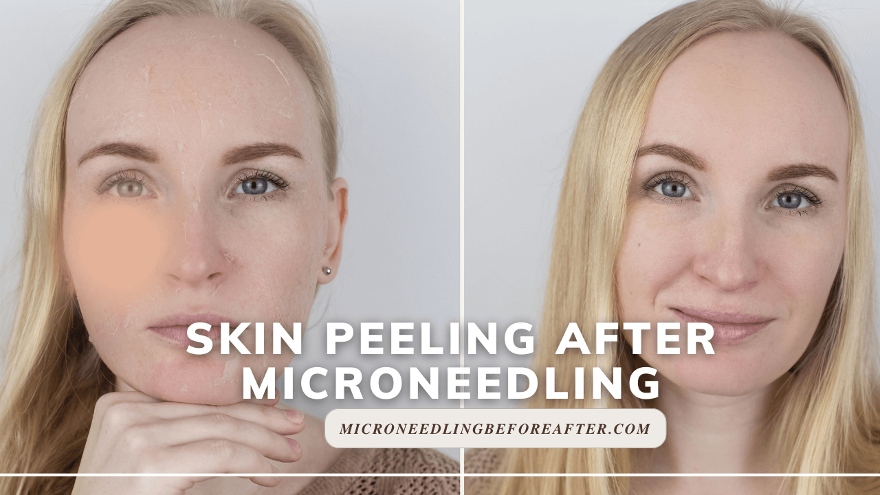 Skin Peeling After Microneedling