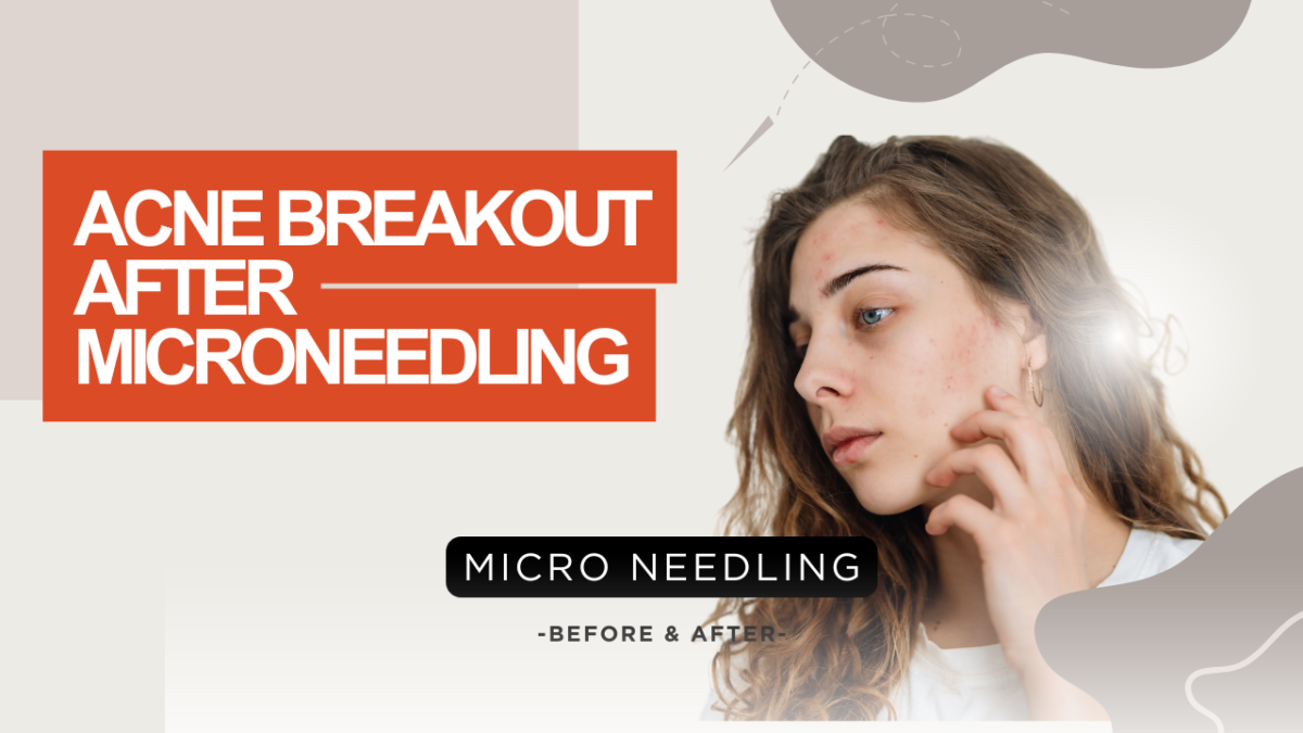 Acne Breakout After Microneedling