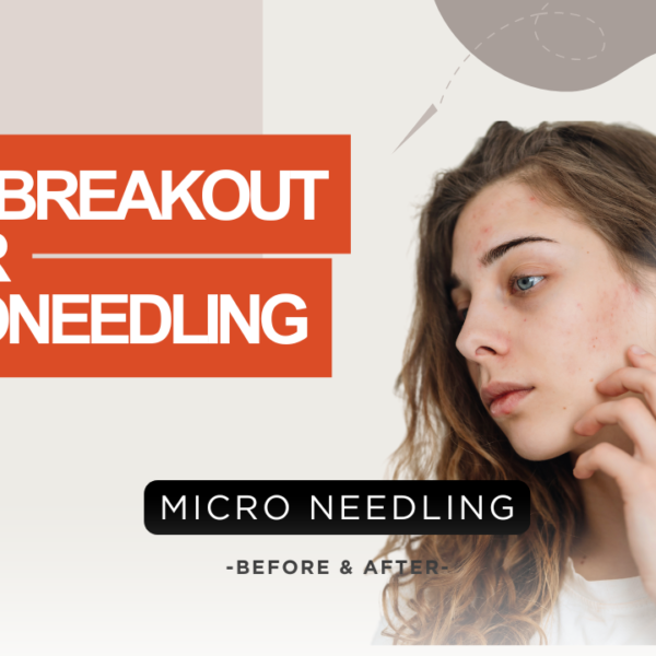 Acne Breakout After Microneedling