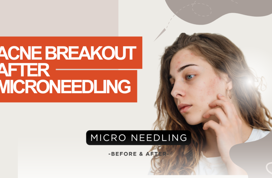 Acne Breakout After Microneedling