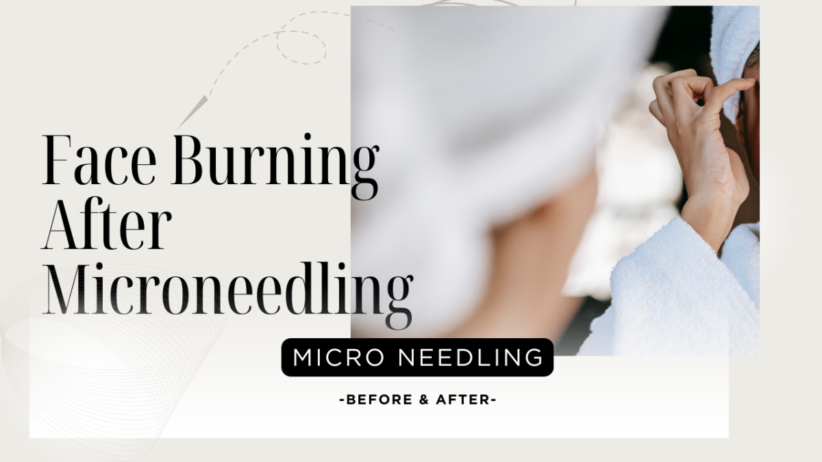 Face Burning After Microneedling