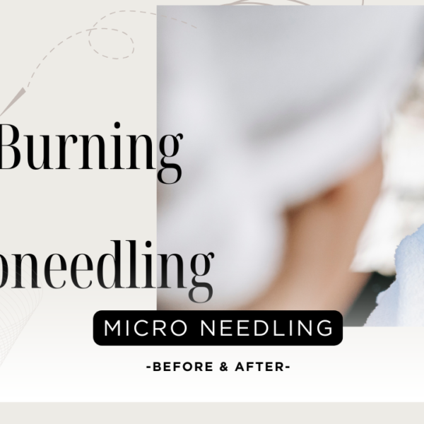 Face Burning After Microneedling