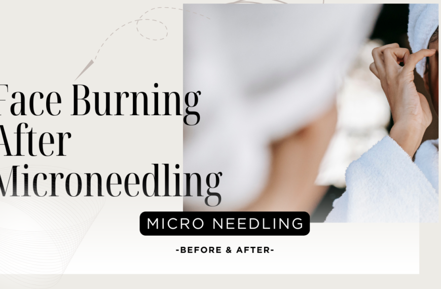 Face Burning After Microneedling