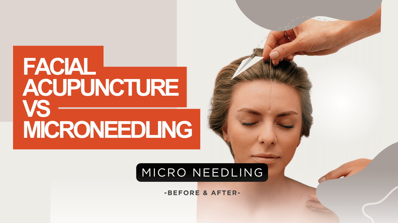 Facial Acupuncture Vs Microneedling