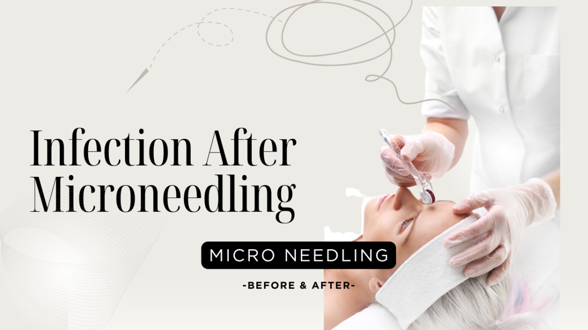 Infection After Microneedling