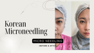 Korean Microneedling
