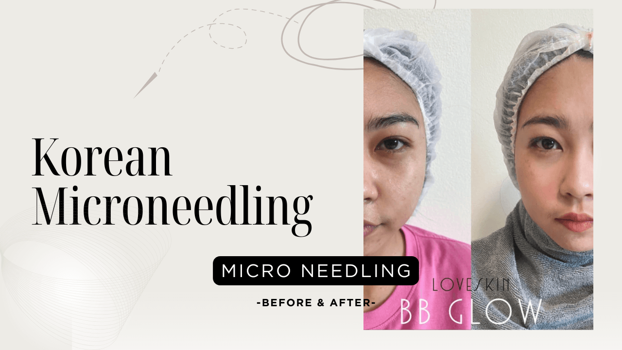 Korean Microneedling