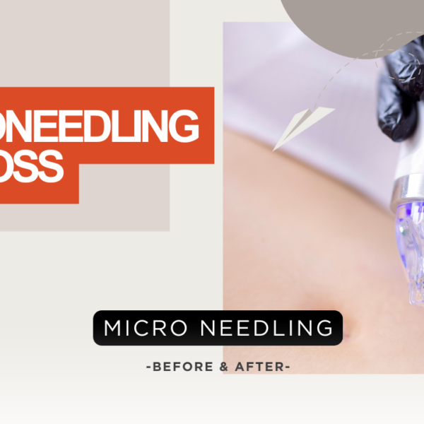 Microneedling Fat Loss