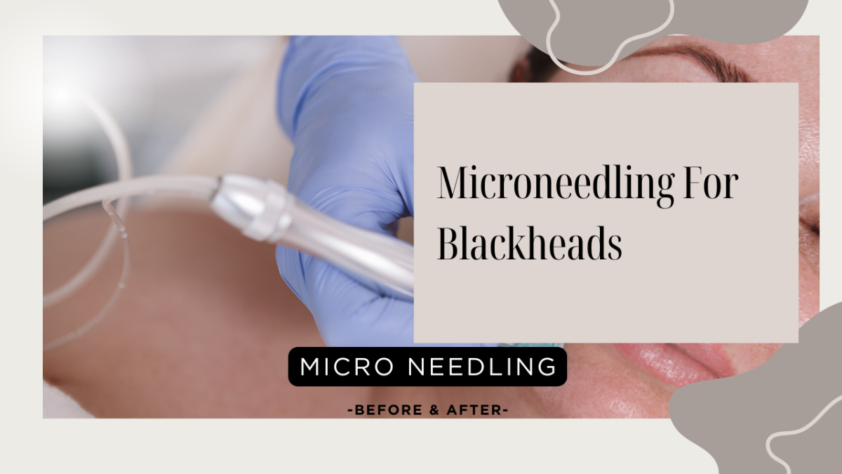 Microneedling For Blackheads