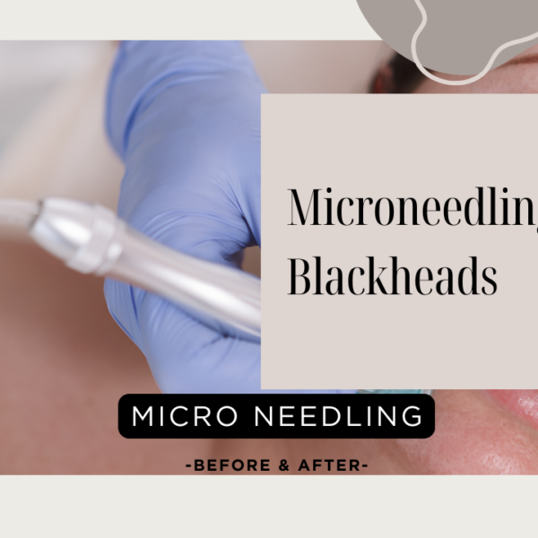 Microneedling For Blackheads