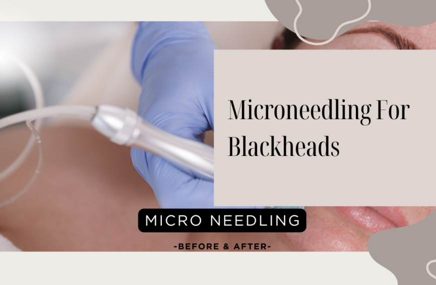 Microneedling For Blackheads