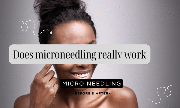 Does Microneedling Really Work?