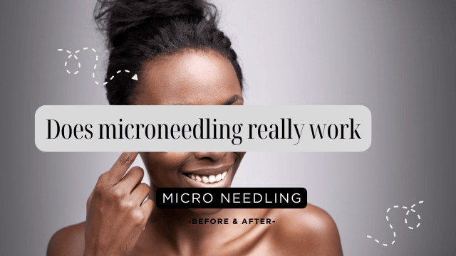 Does Microneedling Really Work?