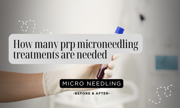 How many prp microneedling treatments are needed