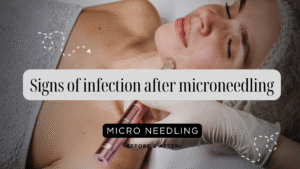 Signs of infection after microneedling