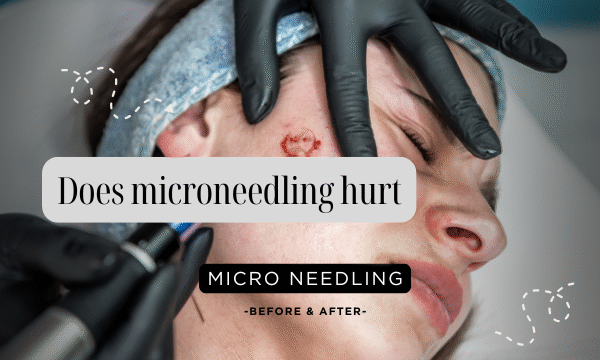 Does microneedling hurt