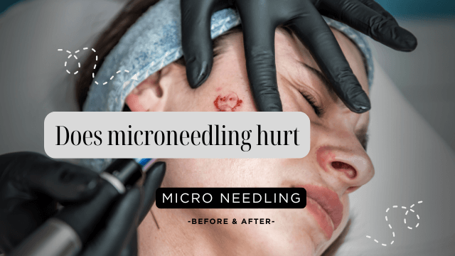 Does microneedling hurt