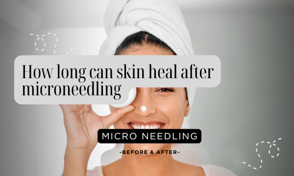 how long can skin heal after microneedling