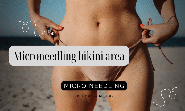 Microneedling bikini area