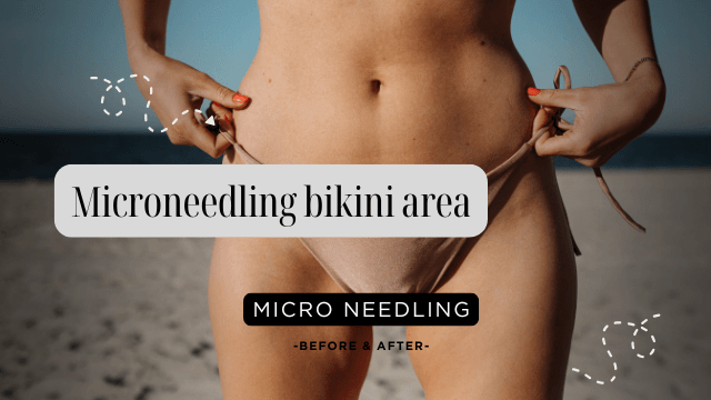 Microneedling bikini area