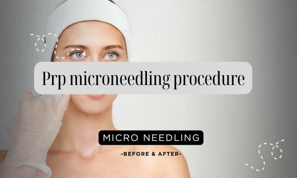 prp microneedling procedure
