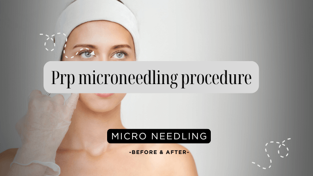  PRP Microneedling Procedure
