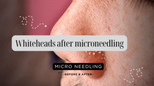 Whiteheads after microneedling