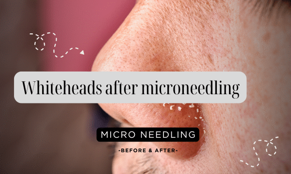 Whiteheads after microneedling
