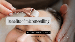 benefits of microneedling