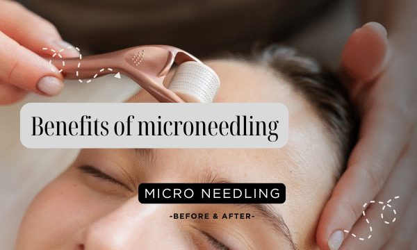 benefits of microneedling