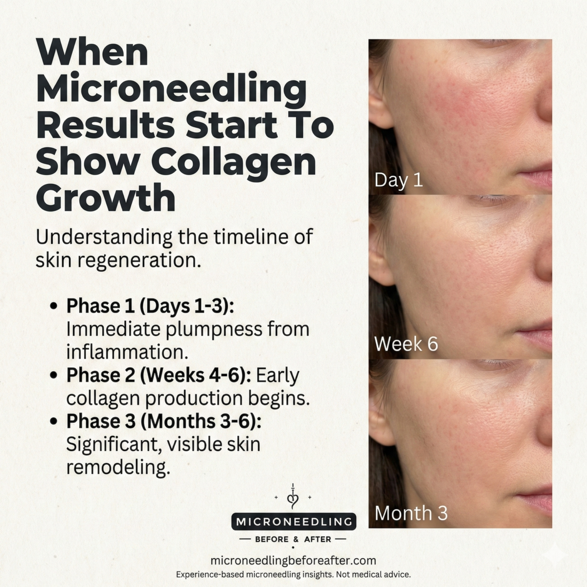 When Microneedling Results Start To Show Collagen Growth