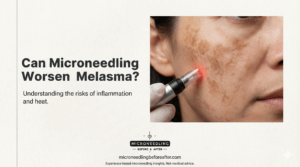 Can Microneedling Worsen Melasma